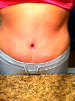 Tummy Tuck After C Section With Dr Manish H. Shah, MD, FACS, Denver Plastic Surgeon