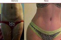 Tummy Tuck Before And After Picture By Doctor Ralph Trey Aquadro, MD, Montgomery Plastic Surgeon