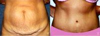 Tummy Tuck Before By Dr. Luis A. Vinas, MD, West Palm Beach Plastic Surgeon