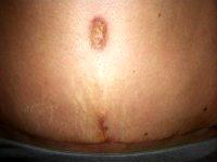 Tummy Tuck Belly With Dr Jules Walters, MD, New Orleans Plastic Surgeon