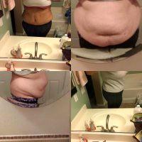 Tummy Tuck Fat Removal Results By Dr. Bryson G. Richards, MD, Las Vegas Plastic Surgeon