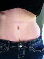 Tummy Tuck With Lipo By Dr. Sofia K. Kirk, MD, Jacksonville Plastic Surgeon