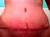 Types Of Tummy Tuck Procedures Candidate