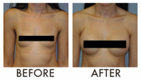 beautiful breast augmentation with Dr. Andrew Kaczynski