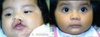 17 or under year old woman treated with Cleft Lip And Palate Repair