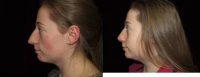 18-24 year old woman treated with Nose Surgery