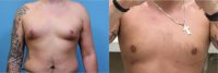 18-24 year old man treated with Smart Lipo for Gynecomastia