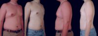 18-24 year old man treated with Male Breast Reduction