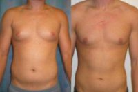 18-24 year old woman treated with Male Breast Reduction