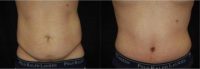 18-24 year old man treated with Tummy Tuck