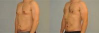 25 yo man treated with liposuction of gynecomastia and abdomen/flanks