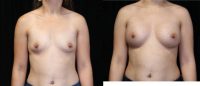25-34 year old woman treated with Breast Implants