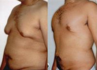 25-34 year old man treated with Male Breast Reduction