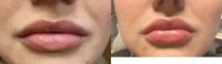 25-34 year old woman treated with lip filler