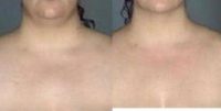 25-34 year old woman treated with Liposuction of the Neck