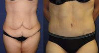 25-34 year old woman treated with Weight Loss