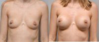 25-34 year old man treated with Breast Augmentation