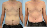 32 year old man treated with Tummy Tuck