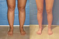 25-34 year old woman treated with Calf Reduction