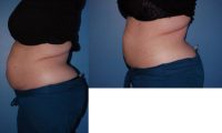 25-34 year old woman treated with SculpSure