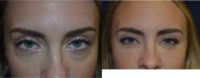 25-34 year old woman treated with lower eye lid fat removal
