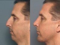 34 yr old male with inhereted large nose and small chin