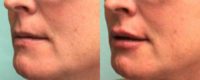 35-44 year old woman treated with Lip Filler
