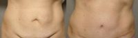 38 year old woman treated with Tummy Tuck
