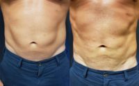 35-44 year old man treated with Emsculpt