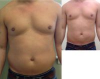 35-44 year Old Man Treated with Smart Lipo