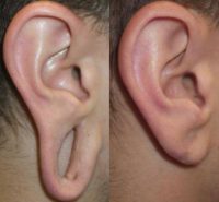 35-44 year old man treated with Earlobe Surgery