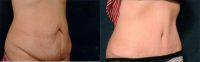 40 Year Old Woman Treated With Tummy Tuck Before By Dr John V. Williams, MD -  Baton Rouge Plastic Surgeon