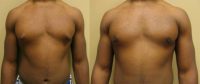 35-44 year old man treated with Liposuction