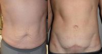 35-44 year old man treated with Tummy Tuck