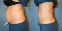 35-44 year old woman treated with Vaser Liposuction