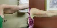 35-44 year old woman treated with Arm Lift