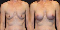 45 y/o, 5'9, 132 lbs, 339 cc silicone breast implants