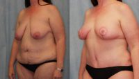 45 year old woman treated with Mommy Makeover