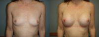 45-54 year old woman treated with Breast Augmentation