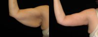 48 y.o. female after weight loss surgery, complains of arm laxity