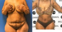 45-54 year old man treated with Tummy Tuck