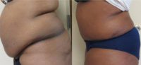 45-54 year old woman treated with Tummy Tuck