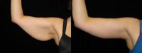 51 y.o. female following weight loss surgery, complains of arm laxity