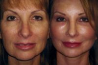 51 year old woman treated with Neck Lift and Facelift