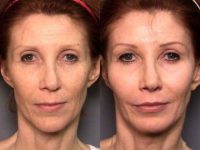 51 yr old female  with  cheeklift (midfacelift ) cheek implants and eye shaping