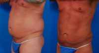 45-54 year old man treated with Liposuction