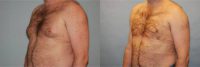 53 year old man treated with liposuction of gynecomastia (no glandular excision required)