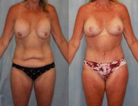 45-54 year old woman treated with Mommy Makeover