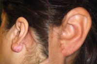 45-54 year old woman treated with Ear Lobe Surgery