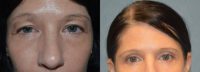54 year old woman treated with Eyelid Surgery
